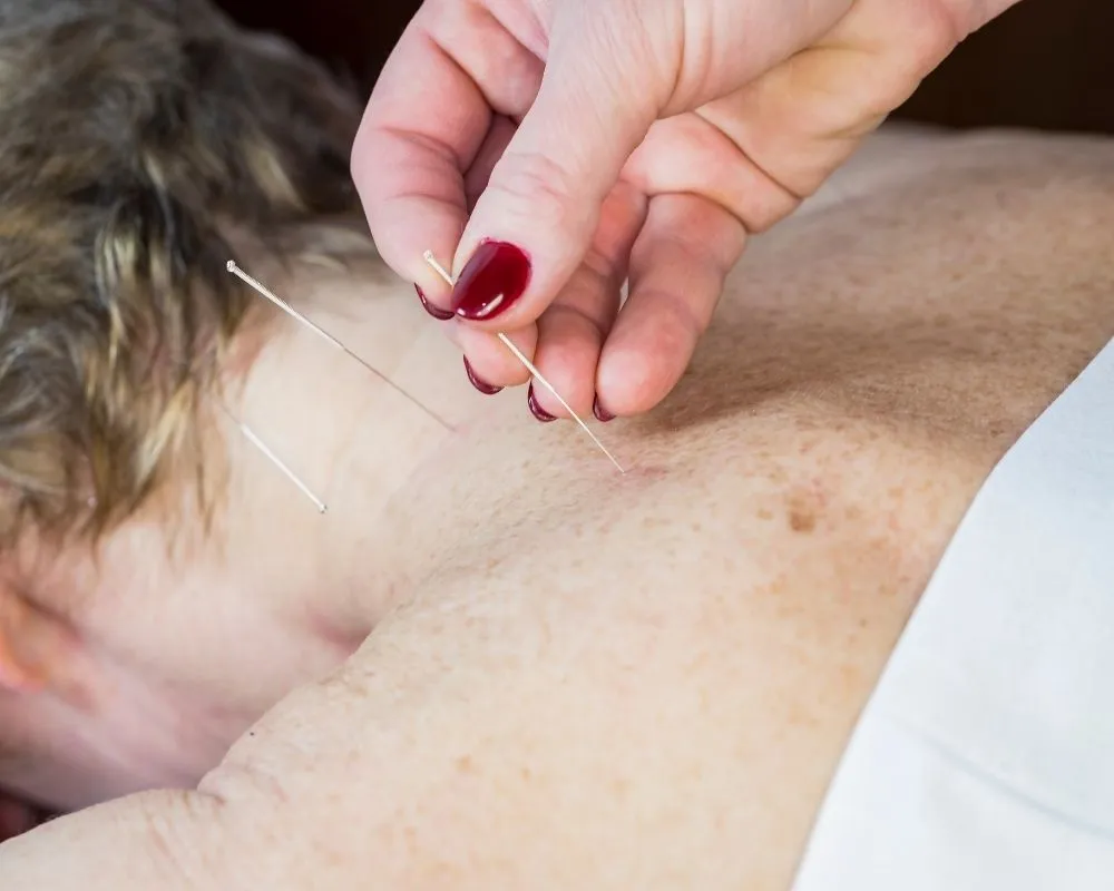 Acupuntura para Dor nas Costas