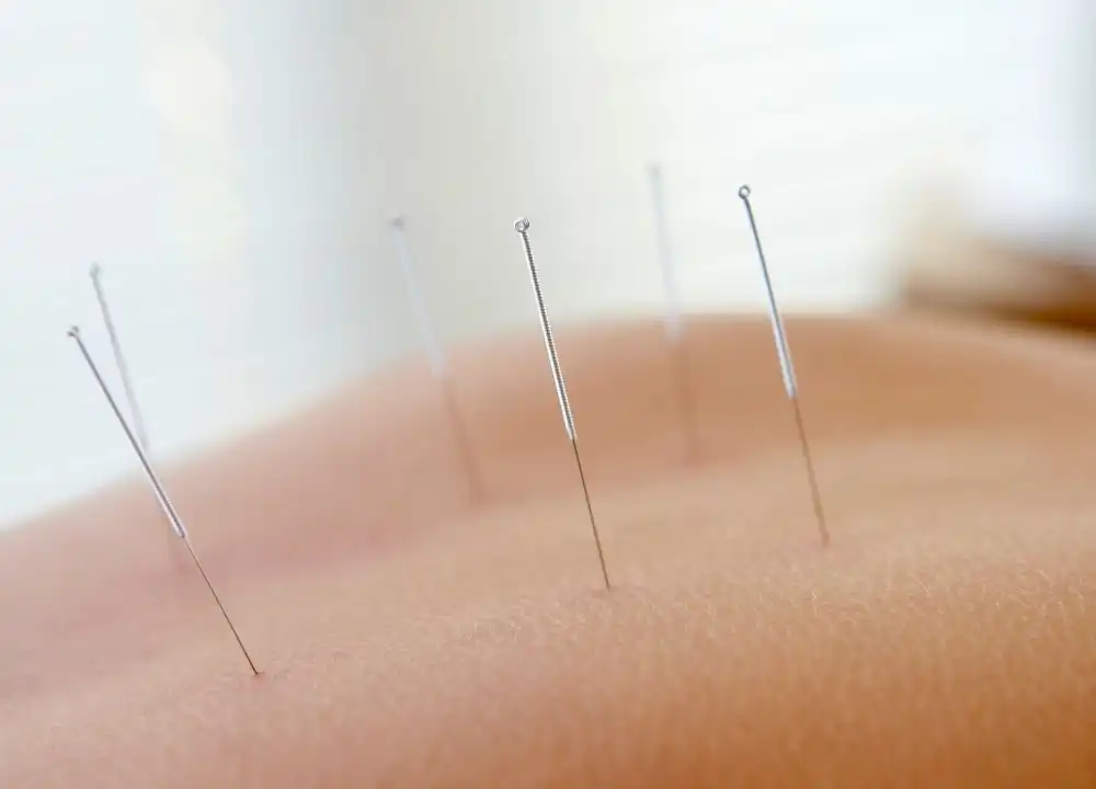 Imagem de capa do artigo: Acupuntura para Dor nas Costas em São Caetano do Sul: Alívio Real e Qualidade de Vida em 2026