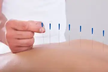 Ilustração do serviço Acupuntura